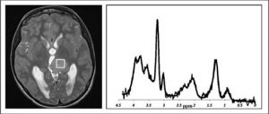 MRI scan and a graph.