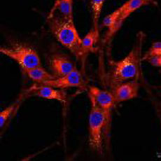 Microscopic imagery of lipid droplets in glioblastoma.