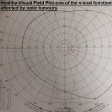 Chart showing a healthy visual field plot-one of the visual function affected by optic tumours.